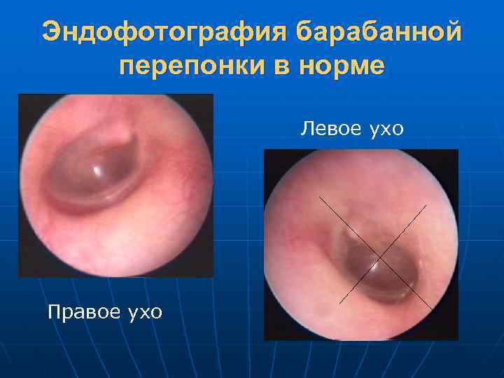Эндофотография барабанной перепонки в норме Левое ухо Правое ухо 