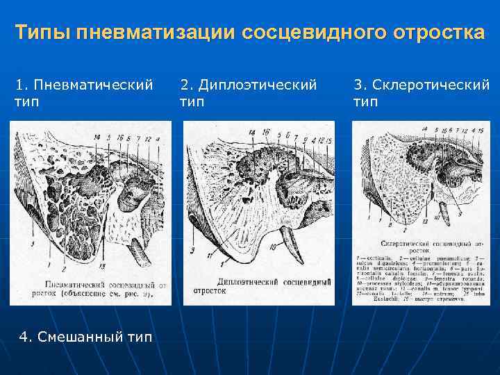 Типы пневматизации сосцевидного отростка 1. Пневматический тип 4. Смешанный тип 2. Диплоэтический тип 3.