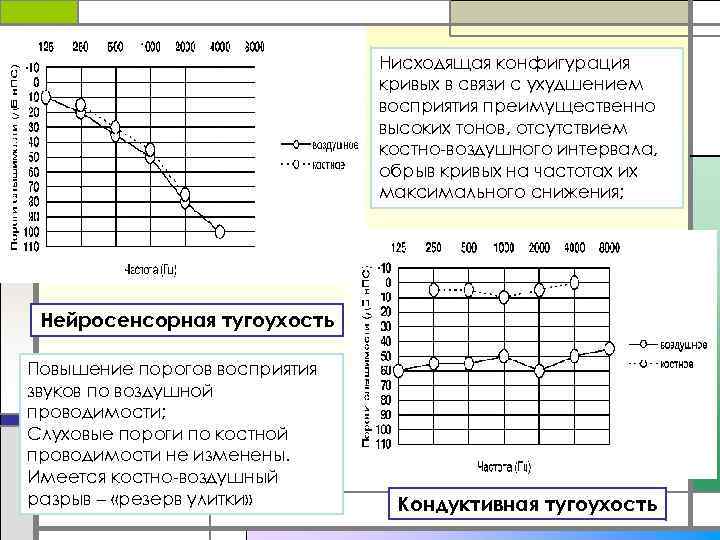 Нисходящая конфигурация кривых в связи с ухудшением восприятия преимущественно высоких тонов, отсутствием костно-воздушного интервала,