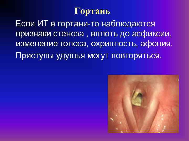 Гортань Если ИТ в гортани-то наблюдаются признаки стеноза , вплоть до асфиксии, изменение голоса,