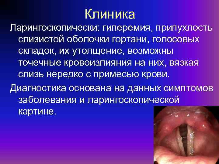 Клиника Ларингоскопически: гиперемия, припухлость слизистой оболочки гортани, голосовых складок, их утолщение, возможны точечные кровоизлияния