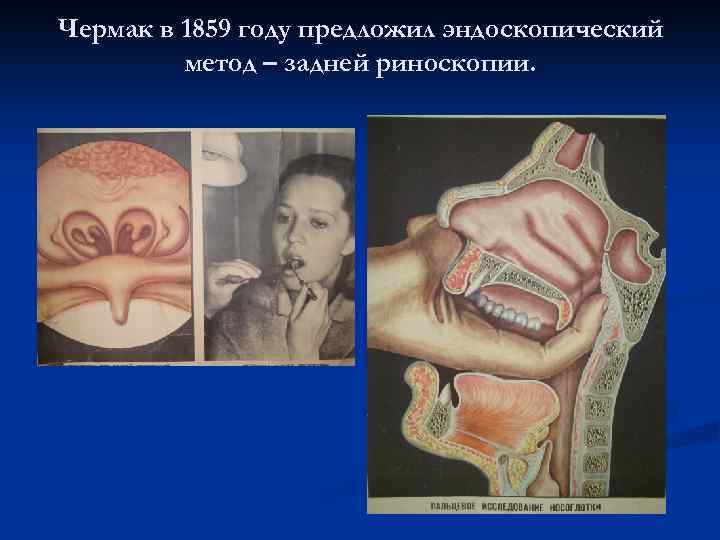 Чермак в 1859 году предложил эндоскопический метод – задней риноскопии. 