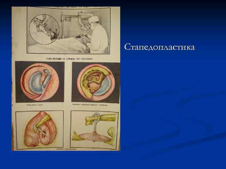 Стапедопластика 