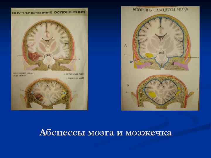 Абсцессы мозга и мозжечка 
