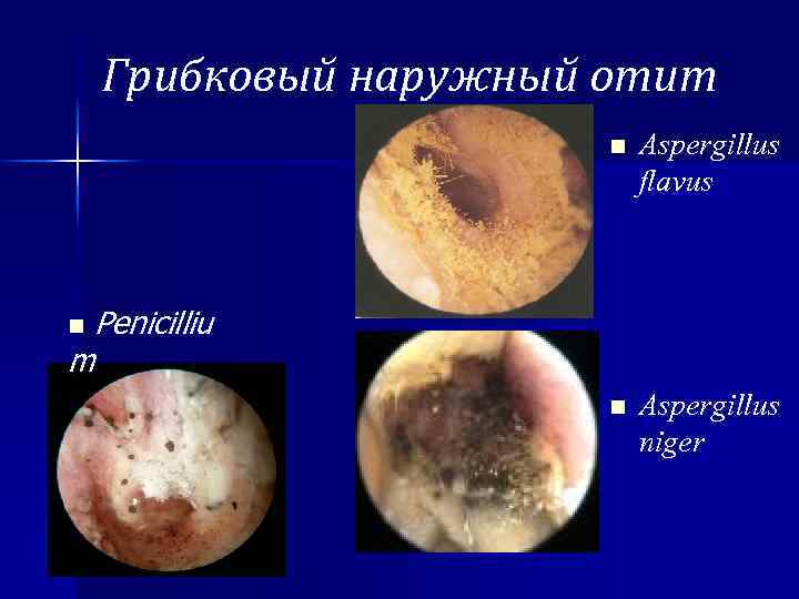Грибковый наружный отит n Aspergillus flavus n Aspergillus niger Penicilliu m n 