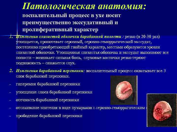Патологическая анатомия: воспалительный процесс в ухе носит преимущественно экссудативный и пролиферативный характер 1. Изменения