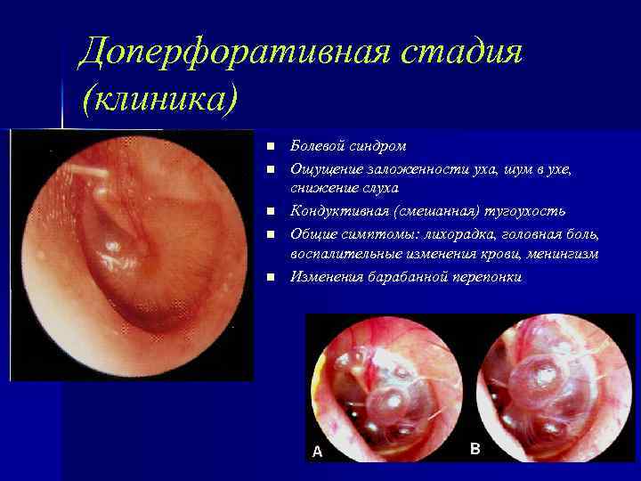 Доперфоративная стадия (клиника) n n n Болевой синдром Ощущение заложенности уха, шум в ухе,