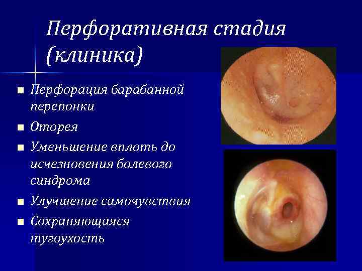 Перфоративная стадия (клиника) n n n Перфорация барабанной перепонки Оторея Уменьшение вплоть до исчезновения