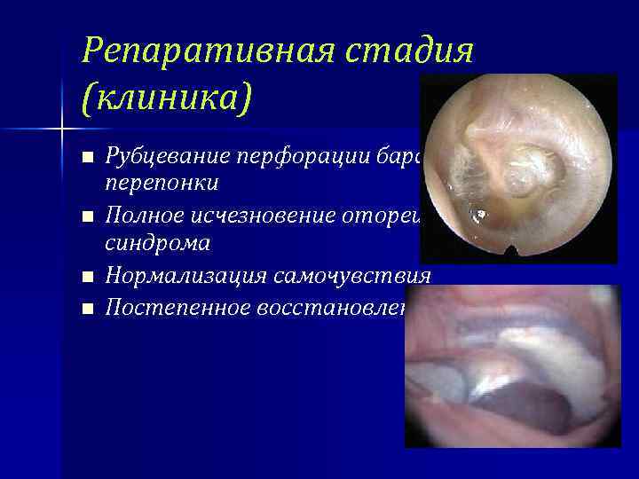 Репаративная стадия (клиника) n n Рубцевание перфорации барабанной перепонки Полное исчезновение отореи и болевого