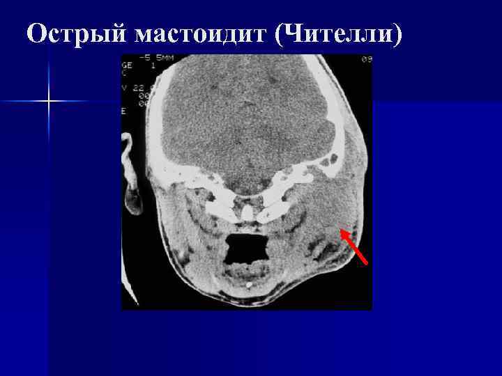 Острый мастоидит (Чителли) 
