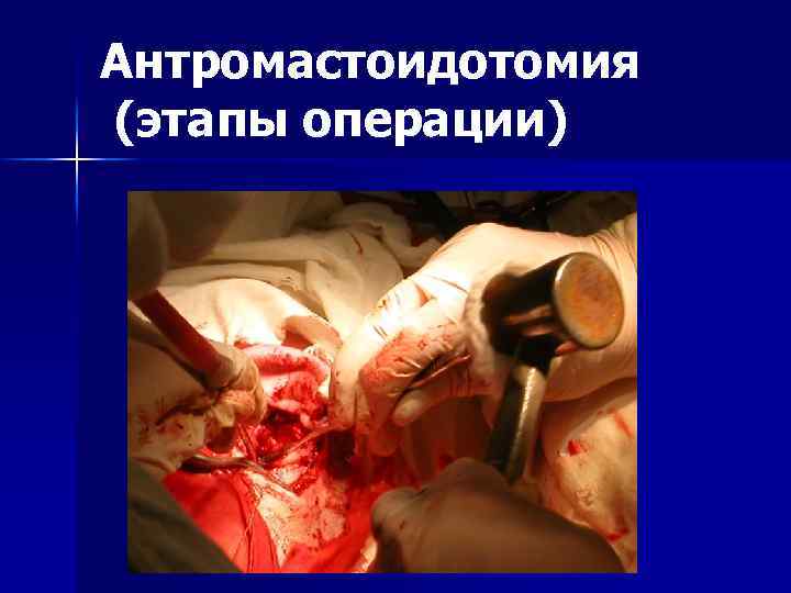 Антромастоидотомия (этапы операции) 