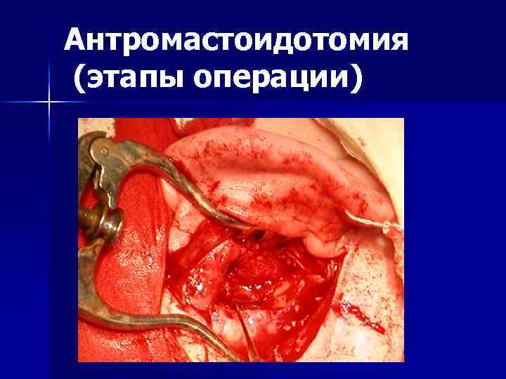 Острые заболевания уха наружный отит острый средний отит