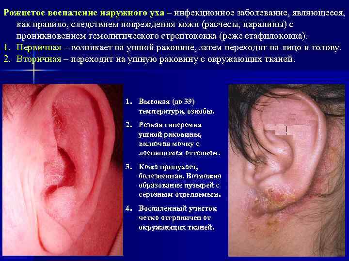 Рожистое воспаление наружного уха – инфекционное заболевание, являющееся, как правило, следствием повреждения кожи (расчесы,