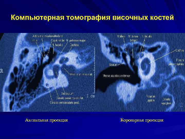 Компьютерная томография височных костей Аксиальная проекция Коронарная проекция 