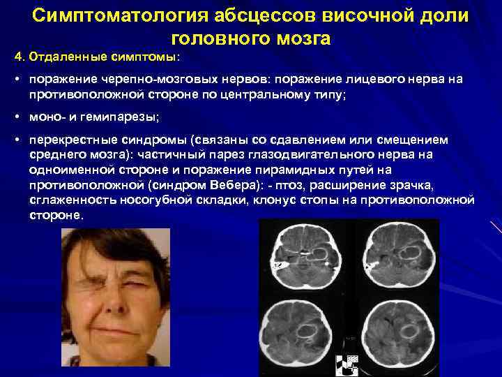 Симптоматология абсцессов височной доли головного мозга 4. Отдаленные симптомы: • поражение черепно-мозговых нервов: поражение