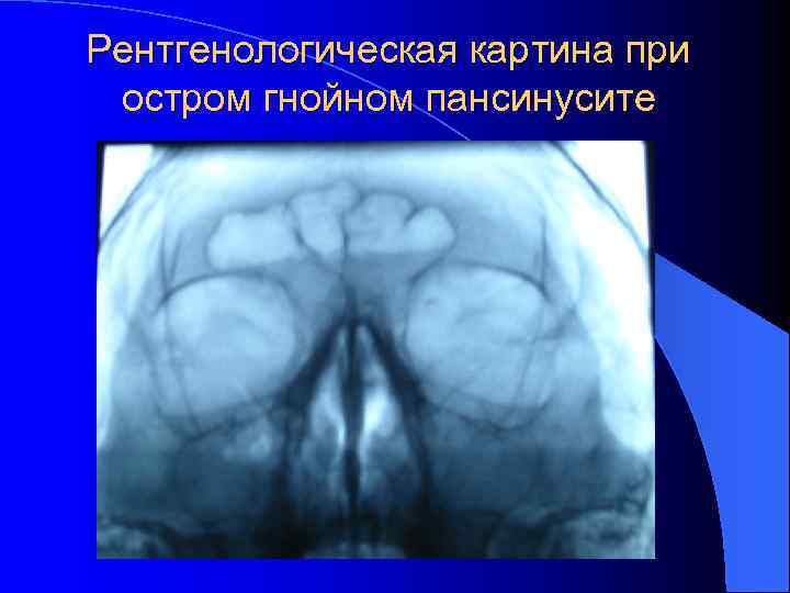 Рентгенологическая картина при остром гнойном пансинусите 