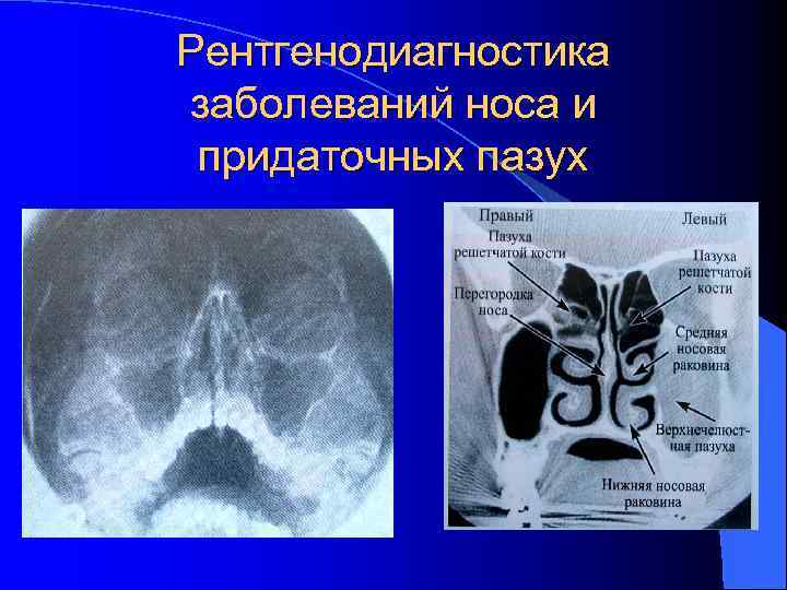 Рентгенодиагностика заболеваний носа и придаточных пазух 