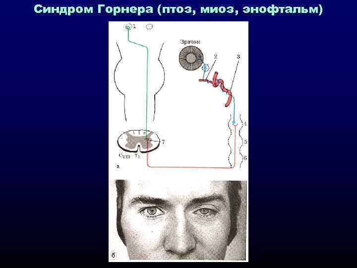 Синдром Горнера (птоз, миоз, энофтальм) 