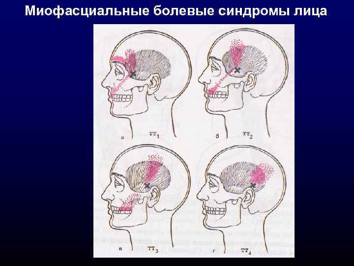 Миофасциальные болевые синдромы лица 