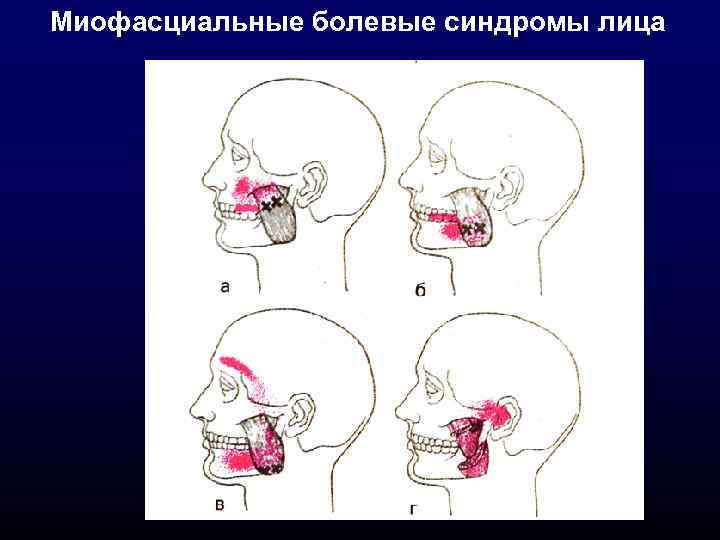 Миофасциальные болевые синдромы лица 