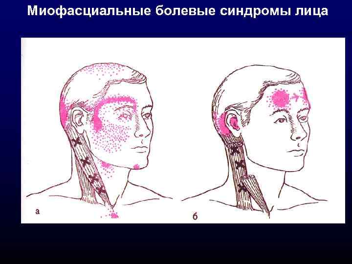 Миофасциальные болевые синдромы лица 