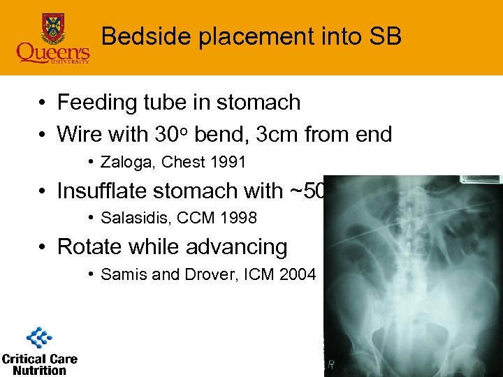 Bedside placement into SB • Feeding tube in stomach • Wire with 30 o