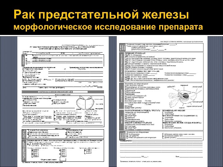 Рак предстательной железы морфологическое исследование препарата 