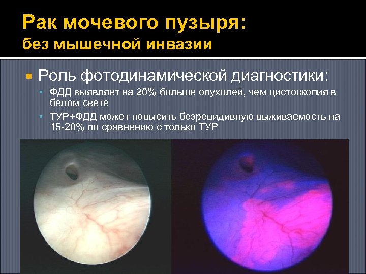 Рак мочевого пузыря: без мышечной инвазии Роль фотодинамической диагностики: ФДД выявляет на 20% больше