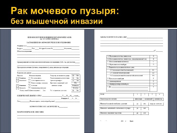 Рак мочевого пузыря: без мышечной инвазии 