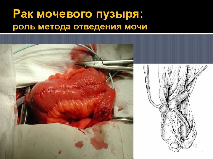 Рак мочевого пузыря: роль метода отведения мочи 