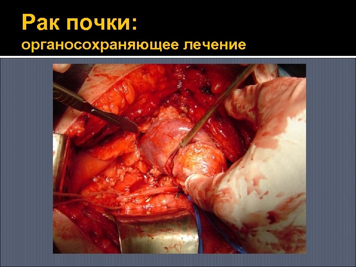 Рак почки: органосохраняющее лечение 