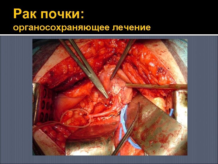 Рак почки: органосохраняющее лечение 