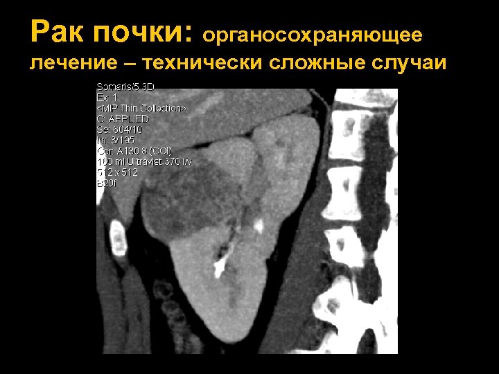 Рак почки: органосохраняющее лечение – технически сложные случаи 