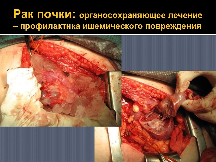 Рак почки: органосохраняющее лечение – профилактика ишемического повреждения 