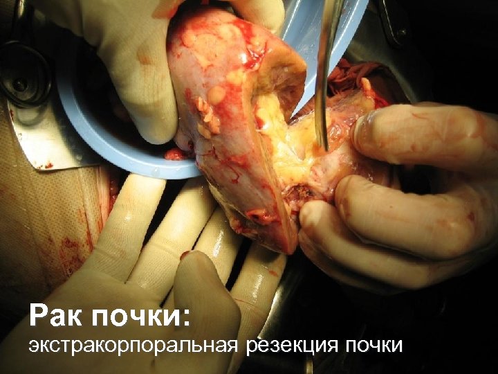 Рак почки: экстракорпоральная резекция почки 