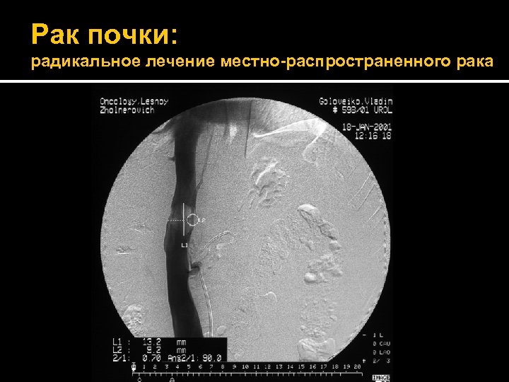 Рак почки: радикальное лечение местно-распространенного рака 