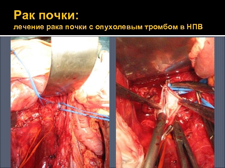 Рак почки: лечение рака почки с опухолевым тромбом в НПВ 