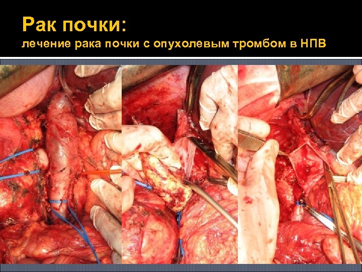 Рак почки: лечение рака почки с опухолевым тромбом в НПВ 