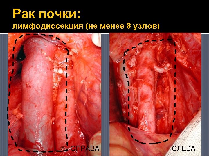 Рак почки: лимфодиссекция (не менее 8 узлов) СПРАВА СЛЕВА 