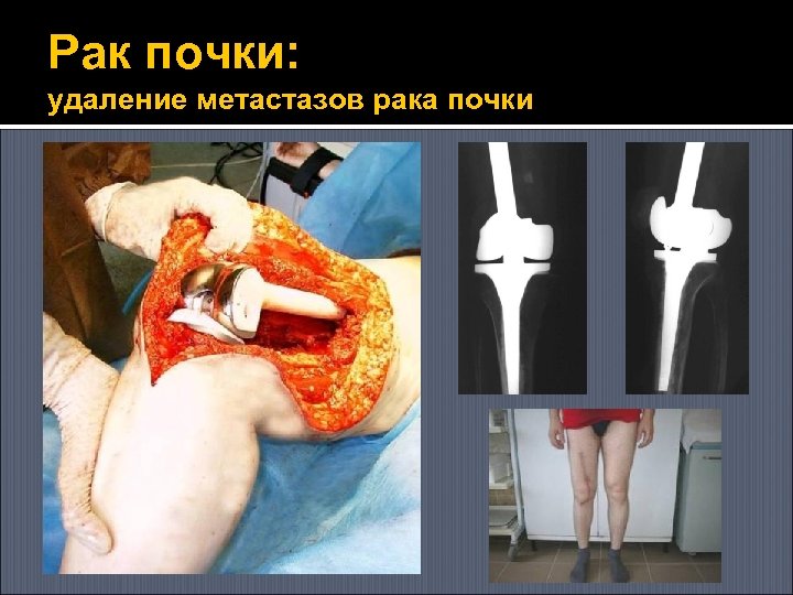 Рак почки: удаление метастазов рака почки 