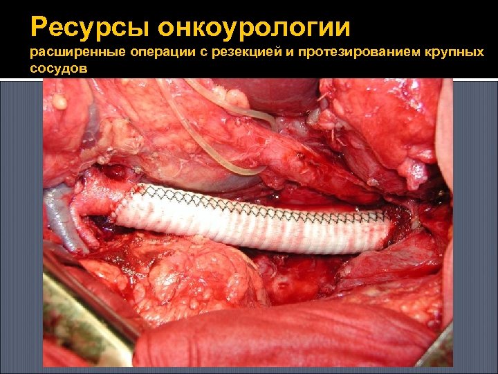 Ресурсы онкоурологии расширенные операции с резекцией и протезированием крупных сосудов 