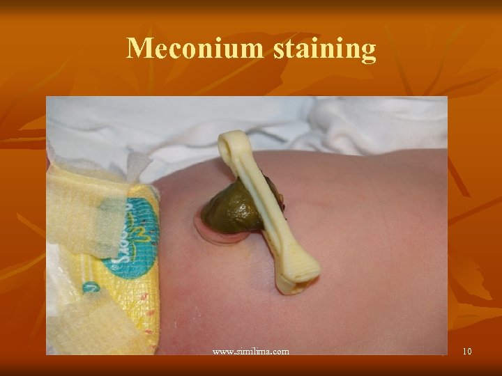 Meconium staining www. similima. com 10 