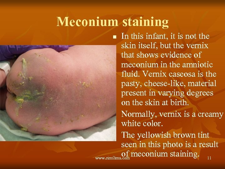 Meconium staining In this infant, it is not the skin itself, but the vernix