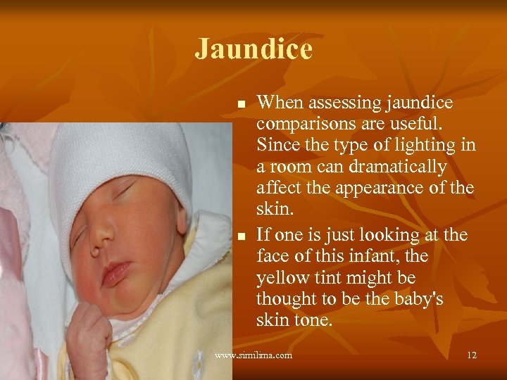 Jaundice n n When assessing jaundice comparisons are useful. Since the type of lighting