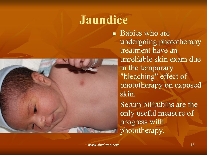 Jaundice n n www. similima. com Babies who are undergoing phototherapy treatment have an