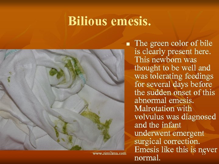 Bilious emesis. n www. similima. com The green color of bile is clearly present