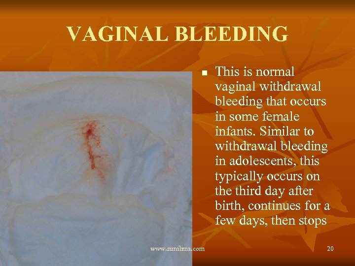 VAGINAL BLEEDING n www. similima. com This is normal vaginal withdrawal bleeding that occurs