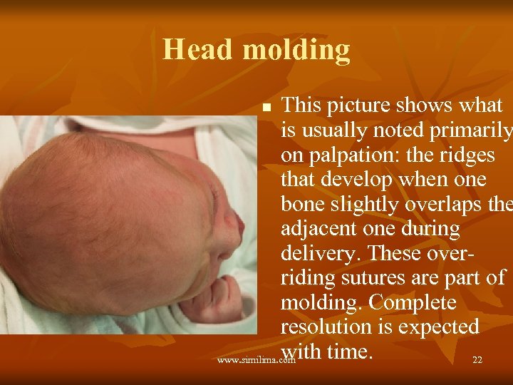 Head molding This picture shows what is usually noted primarily on palpation: the ridges