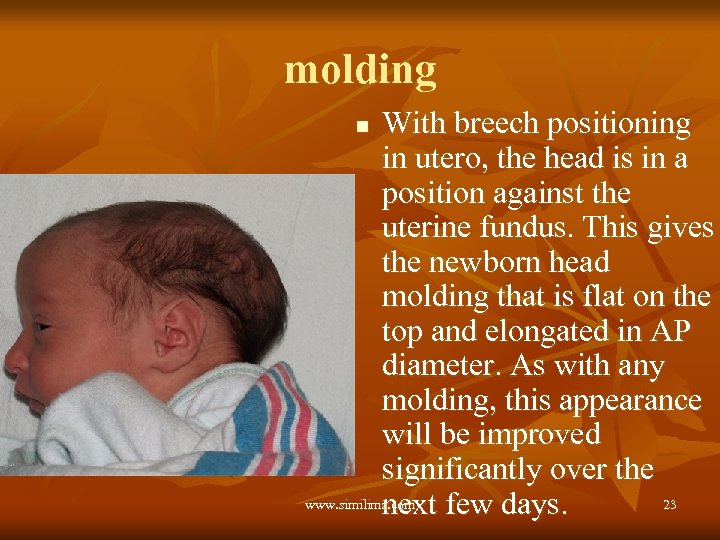 molding With breech positioning in utero, the head is in a position against the