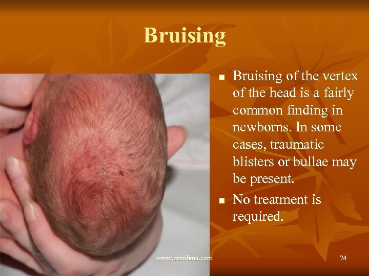 Bruising n n www. similima. com Bruising of the vertex of the head is
